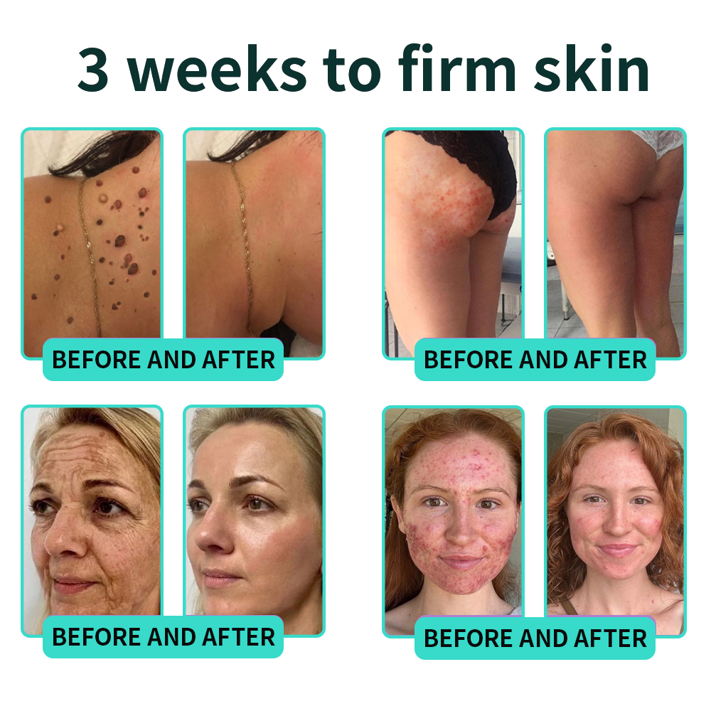 Authorized Flagship Store ✨|🌥️𝑽𝒊𝒕𝒂𝒍𝒊𝒔𝒚𝒔 𝑷𝑫𝑹𝑵 𝑪𝒂𝒑𝒔𝒖𝒍𝒆 𝑪𝒓𝒆𝒂𝒎 100|Anti aging, firming and lifting muscles Skin care, removal of stretch marks, breast enhancement, removal of chest lines, and skin repair.