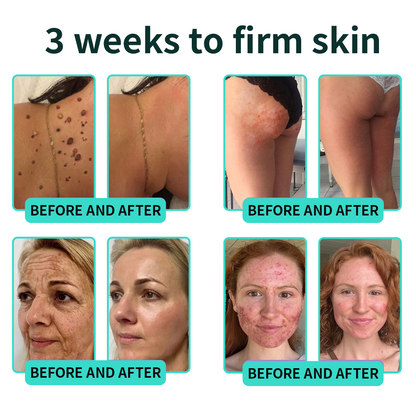 Authorized Flagship Store ✨|🌥️𝑽𝒊𝒕𝒂𝒍𝒊𝒔𝒚𝒔 𝑷𝑫𝑹𝑵 𝑪𝒂𝒑𝒔𝒖𝒍𝒆 𝑪𝒓𝒆𝒂𝒎 100|Anti aging, firming and lifting muscles Skin care, removal of stretch marks, breast enhancement, removal of chest lines, and skin repair.