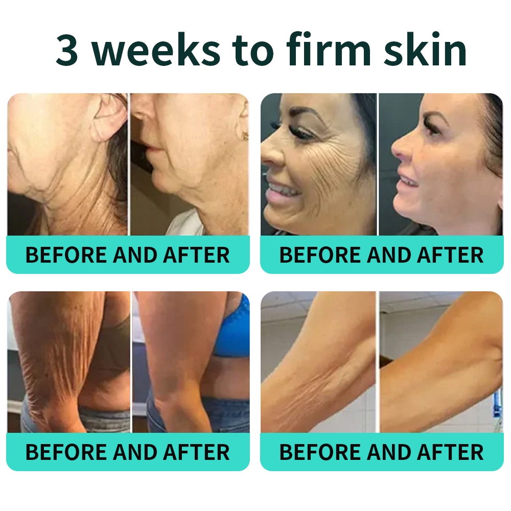 Authorized Flagship Store ✨|🌥️𝑽𝒊𝒕𝒂𝒍𝒊𝒔𝒚𝒔 𝑷𝑫𝑹𝑵 𝑪𝒂𝒑𝒔𝒖𝒍𝒆 𝑪𝒓𝒆𝒂𝒎 100|Anti aging, firming and lifting muscles Skin care, removal of stretch marks, breast enhancement, removal of chest lines, and skin repair.
