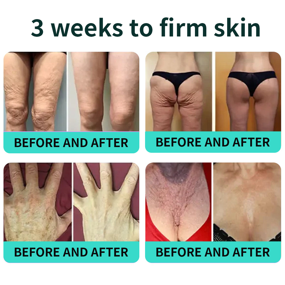 Authorized Flagship Store ✨|🌥️𝑽𝒊𝒕𝒂𝒍𝒊𝒔𝒚𝒔 𝑷𝑫𝑹𝑵 𝑪𝒂𝒑𝒔𝒖𝒍𝒆 𝑪𝒓𝒆𝒂𝒎 100|Anti aging, firming and lifting muscles Skin care, removal of stretch marks, breast enhancement, removal of chest lines, and skin repair.